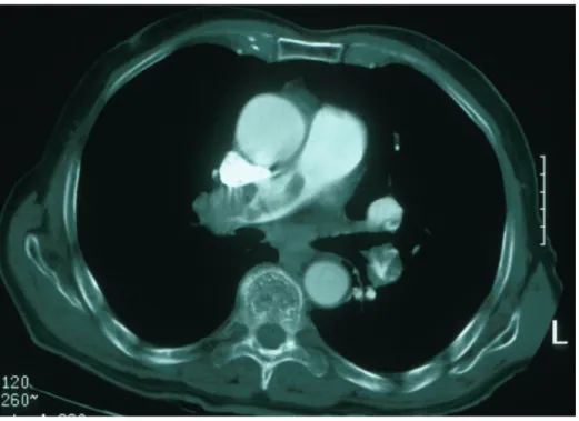 Figure 1 –  Angioscanner pulmonaire montrant un volumineux thrombus obstruant  l’artère pulmonaire droite, associé à des emboles lobaires gauches