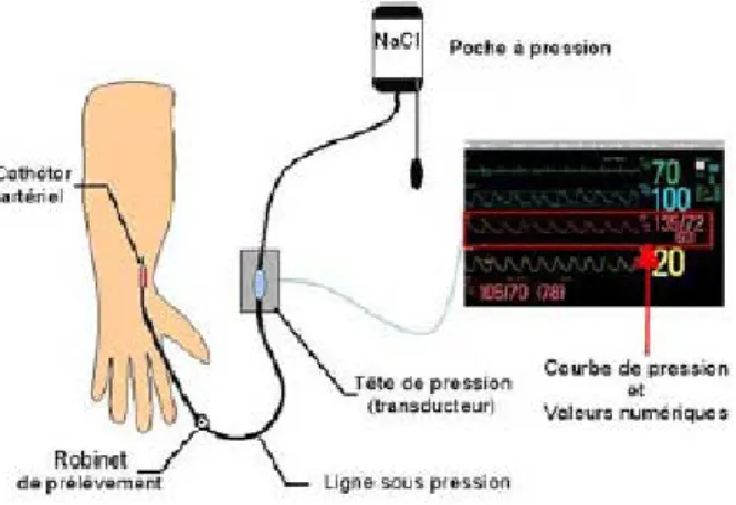 Figure 1. Technique de mesure continue et invasive de la pression artérielle 