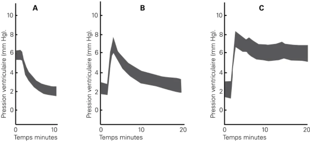 Figure  1  :  Variations  de  la  pression  ventriculaire  après  ponction  lombaire  ou  injections épidurales