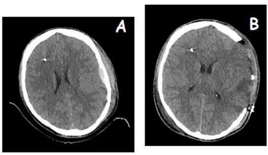 Figure  1.  la  craniectomie  décompressive  permet  l’expansion  du  cerveau  au-delà  de  la  boite  crânienne