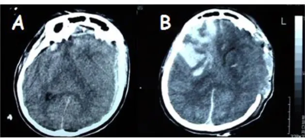 Figure 3. Patient avec traumatisme crânien grave. A-Scanner à l’arrivée : l’hématome sous- sous-dural  gauche,  l’œdème  diffus  et  l’hypertension  intracérébrale  résultante  entraînera  une  décision de craniectomie décompressive