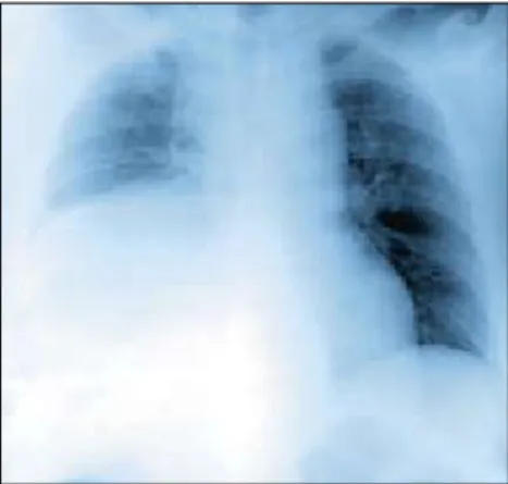 Figure 1. ascension de la coupole  diaphragmatique droite.