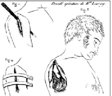 Figure 8 : Procédé opératoire de la désarti- désarti-culation de l’épaule selon J.D. Larrey  [1] 
