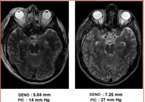 Figure 5 : Exemple de mesure du DENO par IRM dans 2 situations : avec et sans HTIC.