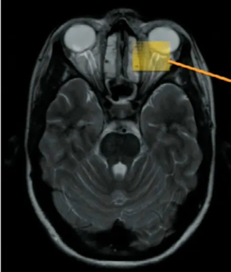 Figure 4 : Mesure du DENO par IRM.