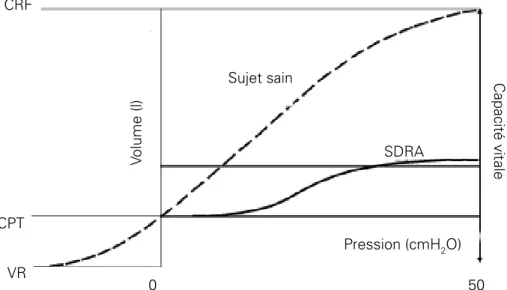 Figure 2 :  Courbe Pression/Volume chez un patient atteint de SDRA et chez un  sujet sain