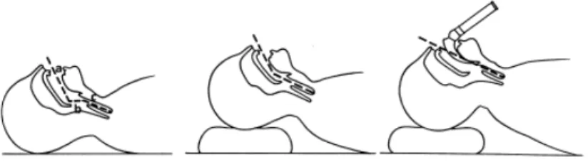 Fig 1. Position modifiée de Jackson. La position de la tête, la mise en plaœ d' un coussin  sous l'occiput et le laryngoscope permettent d'aligner les trois axes (a: axe buccal; b: axe  pharyngé; c: axe laryngé) et de visualiser la glotte