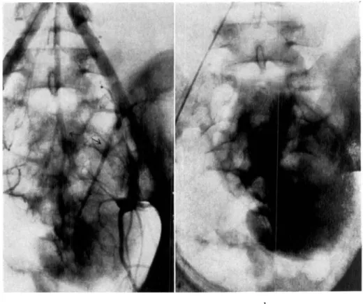 Fig.  4.  Left-sided  ectopic  kidney  in  pelvis.  (Right kidney  absent.)  Blood  supply  by  one artery from the iliac bifurcation and one from the left internal iliac artery