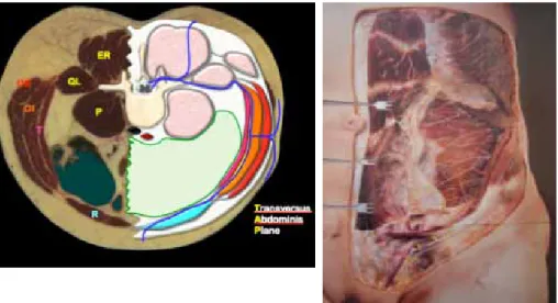 Figure 1 :  à gauche, coupe axiale passant par T10 et montrant le nerf T10 chemi- chemi-nant dans la paroi et son passage dans le plan du transverse entre les muscles  oblique interne (OI) et transverse (T) a droite, l’ensemble des derniers nerfs  thoraciq