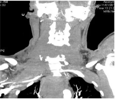 Figure 2. Exemple de reconstruction tomodensitométrique : disjonction du rachis  cervical 