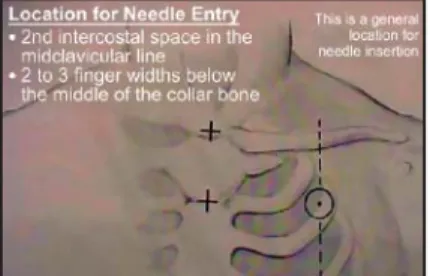 Figure 2-17. Needle chest compression, needle insertion site Chest Tube Insertion