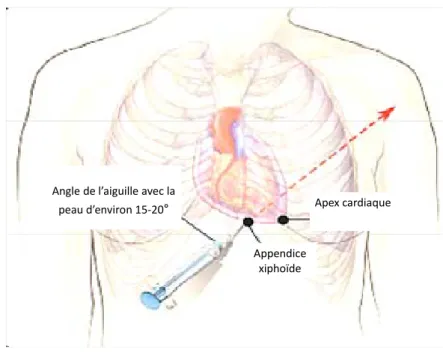 Figure 5.- Représentation schématique d’une péricardocentèse (ponction sous-xiphoïdienne dirigée vers l’épaule 