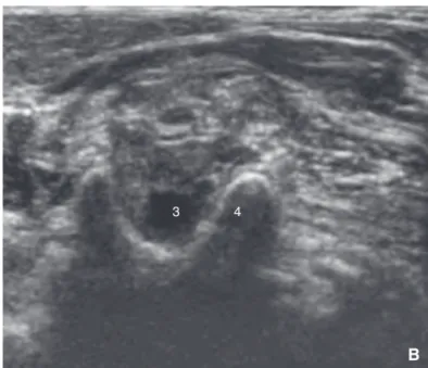 Figure 7. Bloc interscalénique : repérage échographique. La bifurcation caro- caro-tidienne se produit habituellement en C4 (A)