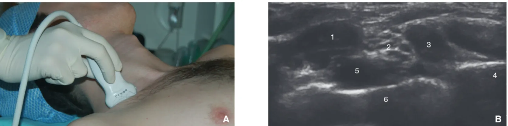 Figure 9. Bloc supraclaviculaire. Repérage échographique (A, B). 1. Muscle scalène antérieur ; 2