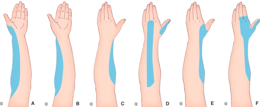 Figure 3. Variations des territoires sensitifs cutanés du nerf cutané latéral de l’avant-bras, branche sensitive cutanée du nerf musculocutané (A à F) (d’après [145] )