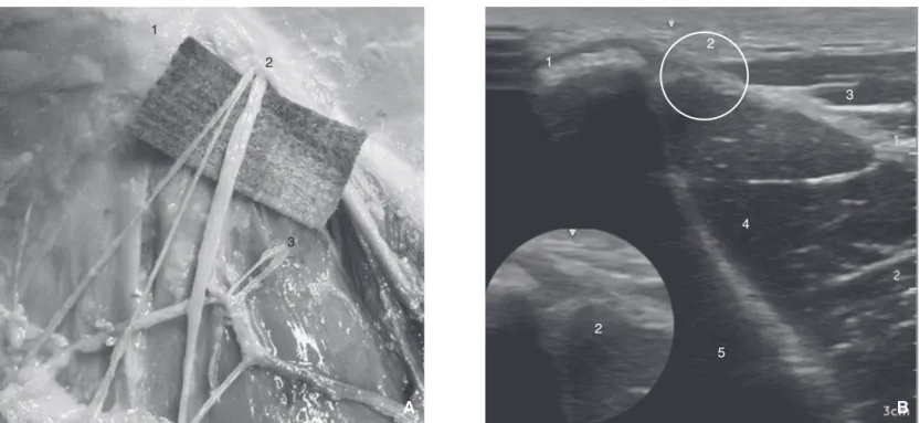 Figure 9. Bloc du nerf cutané latéral de la cuisse. Dissection anatomique et coupe échographique.