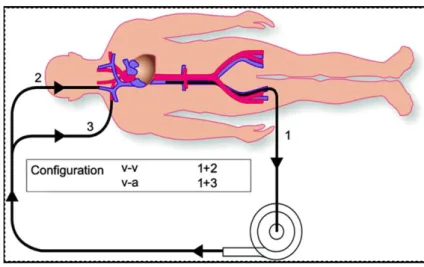 Figure 1.- Principe de l’ECLS (mode veino-artériel, v-a) et de l’ECMO (mode veino-veineux, v-v)