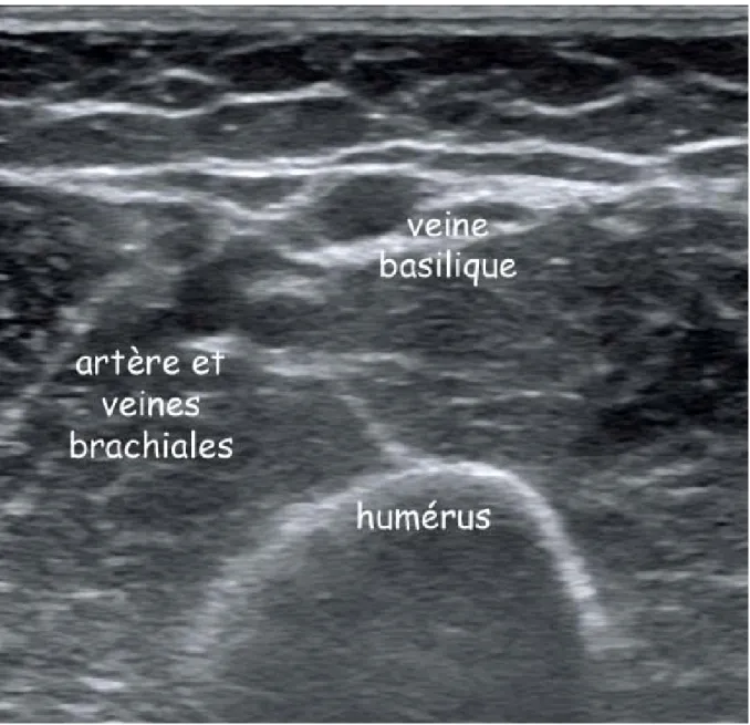 Figure 6.- Coupe transversale à la face interne du 1/3 distal du bras montrant le paquet  brachial vasculo-nerveux et la veine basilique