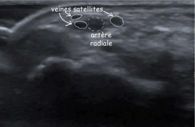 Figure 7.- Coupe transversale de l’artère radiale et de ses veines satellites au poignet