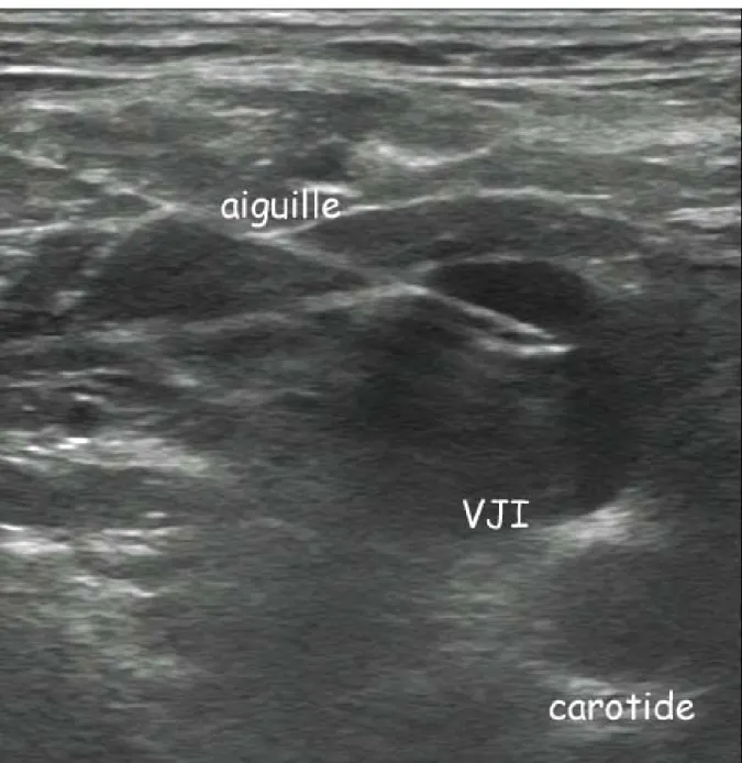 Figure 9.- Abord postérieur « dans le plan » de la veine jugulaire interne (VJI). Noter les  échos de répétition de l’aiguille ainsi que l’aspect caractéristique du biseau qui est ici tourné  vers le bas