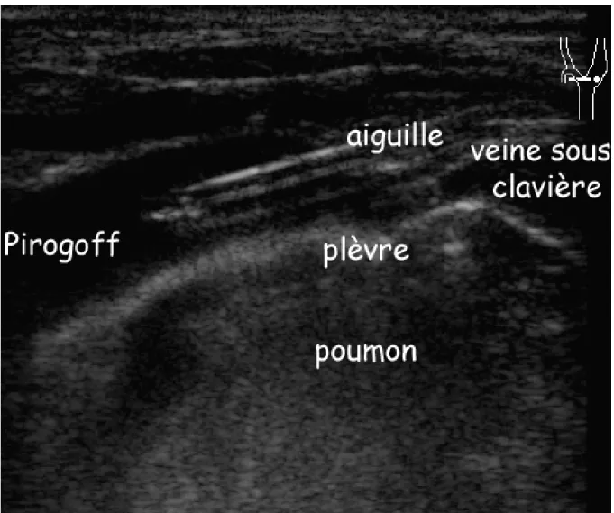 Figure 10.- Abord sus-claviculaire « dans le plan » du confluent de Pirogoff à gauche