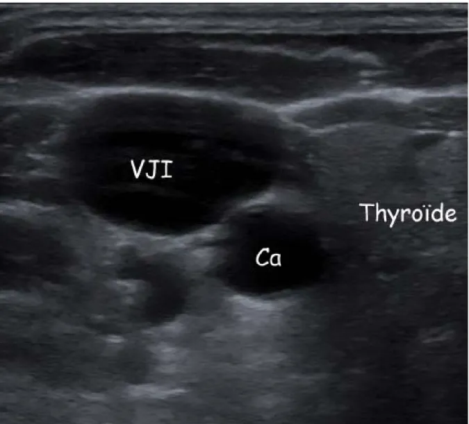 Figure 1.- Coupe échographique au sommet du triangle de Sédillot avec le lobe thyroïdien  droit, la carotide (Ca) et la veine jugulaire interne (VJI)