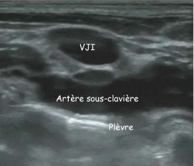 Figure 2.- Coupe échographique à la base du cou à droite montrant la VJI en coupe  transversale, l’artère sous-clavière en coupe longitudinale et la plèvre