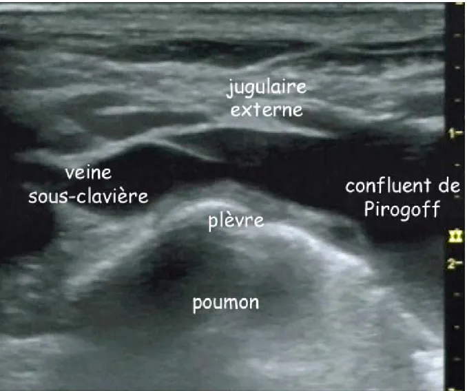 Figure 3.-  Coupe échographique à la base du cou, au ras de la clavicule, avec la veine sous- sous-clavière, les 2 derniers cm de la veine jugulaire externe, le confluent de Pirogoff (veine  brachiocéphalique) et le dôme pleural