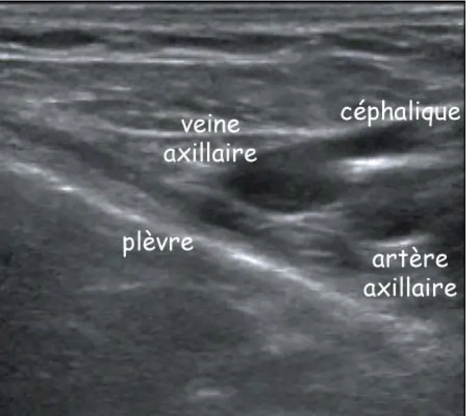 Figure 4.- Coupe échographique à 90° du sillon delto-pectoral à gauche montrant la veine  axillaire, la crosse de la céphalique et l’artère axillaire