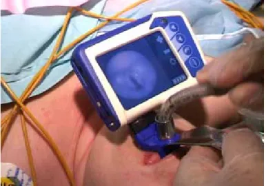 Figure 1 :  utilisation du LMA CTrach® lors d’une intubation difficile. Le LMA est  positionné de manière optimale en regard de la glotte
