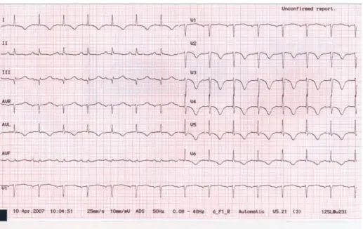 Figure 2 –  ECG à 48 h d’une patiente présentant un syndrome de Tako-tsubo