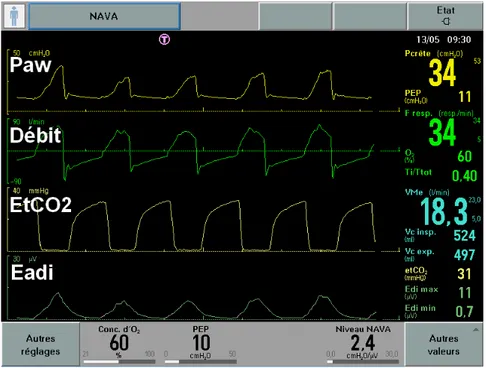 Figure 5.- Capture d’écran d’un ventilateur en mode NAVA. De haut en bas, les courbes de pression des voies  aériennes (Paw), de débit, de capnie expiratoire (EtCO 2 ) et d’activité électrique du diaphragme (Eadi)
