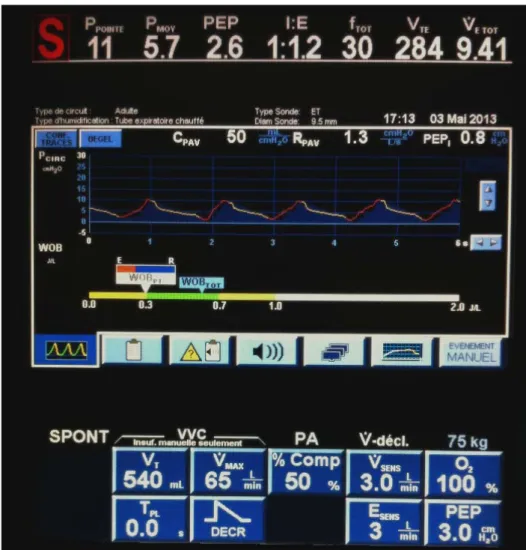 Figure 6.- Capture d'écran d'un ventilateur en mode PAV +. De haut en bas, la courbe de pression en  fonction du temps et la participation du travail ventilatoire du patient (WOB PT) au travail ventilatoire  total (WOB TOT)