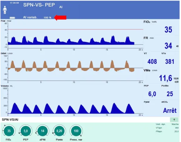 Figure 8.- Capture d'écran d'un ventilateur en mode Noisy PSV avec AI variable à 100 % (flèche)