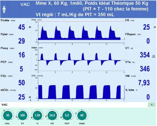 Figure 2.- Capture d'écran d'un ventilateur en mode volumétrique. De haut en bas les courbes de pression  des voies aériennes (Paw), de débit et de capnie expiratoire en fonction du temps