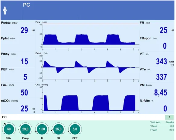 Figure 3.- Capture d'écran d'un ventilateur en mode barométrique. De haut en bas les courbes de pression  des voies aériennes (Paw), de débit et de capnie expiratoire en fonction du temps
