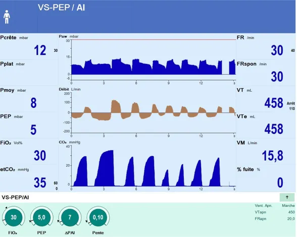 Figure 4.- Capture d'écran d'un ventilateur en mode VS-AI. De haut en bas les courbes de pression des  voies aériennes (Paw), de débit et de capnie expiratoire en fonction du temps