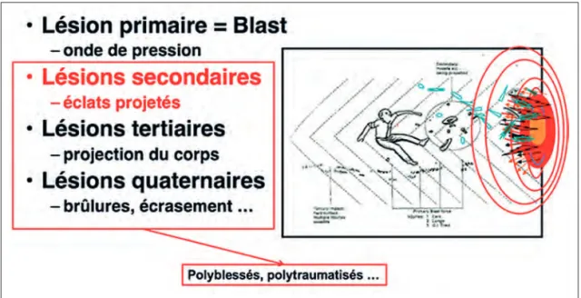 Figure 5 –   Les différents types de lésions par explosion