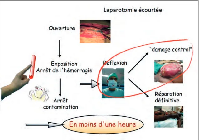 Figure 2 –   Tactique chirurgicale de damage control chirurgical