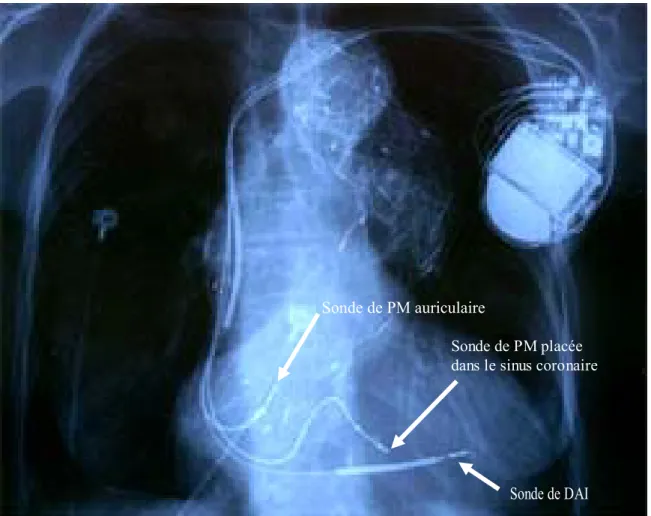 Figure 1 : Défibrillateur implantable automatique (DAI) associé à un stimulateur cardiaque implantable triple  chambre pour resynchronisation cardiaque chez un patient porteur d’une cardiopathie dilatée à coronaire saine 