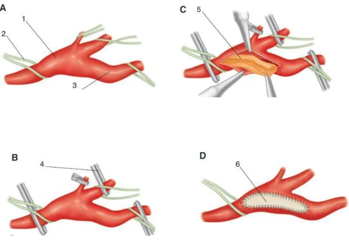 Figure 1 : Endartériectomie carotidienne. Dissection des vaisseaux carotidiens (A) ; clampage de  la bifurcation carotidienne après héparinisation (B) ; thrombo-endartériectomie (C) ; fermeture  de 