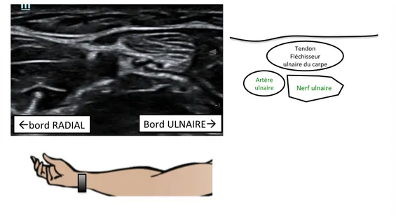 Figure 6 : bloc ulnaire à l’avant-bras  Bloc médian à l’avant-bras  