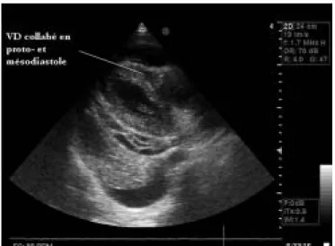 Figure 2. Exemple de flux Doppler lors de tamponnade (vue apicale  4 cavités). Flux Doppler pulsé aortique objectivant des  varia-tions respiratoires importantes, attestant l’effet tamponnade  de l’épanchement péricardique.