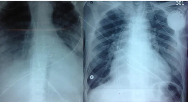 Figure 3 : Radiographie de thorax au lit, objectivant une canule d’admission correctement  positionnée au niveau de la jonction de la veine cave inférieure et de l’oreillette droite (à  gauche) et une canule d’admission positionnée trop haut au niveau de l