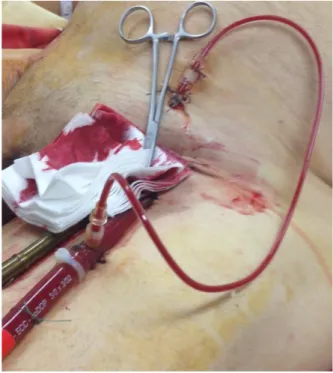 Figure 1 :  Canule de reperfusion de  l’artère  fémorale  superficielle  après  implantation d’une  canule artérielle fémorale gauche dans le cadre d’une ECMO VA périphérique