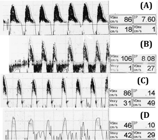 Figure 1 :  Doppler transcranien de l’artère cérébrale moyenne au cours de la progression 