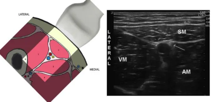 Figure 5 : Selon Manickam et al.  15  Représentation schématique du canal des adducteurs (1 =  muscle  vaste  médial,  2  muscle  sartorius,  3  =  muscle  long  adducteur,  4  =  muscle  adducteur  moyen,  5  =  artère  fémorale,  6  nerf  fémoral,  7  =v