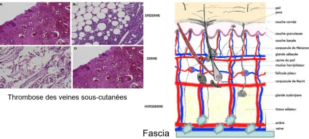 Figure 1 : Coupe anatomopathologie montrant la thrombose des artères et des veines sous- sous-cutanées – Schéma de l’atteinte micro-vasculaire dans la FNC 