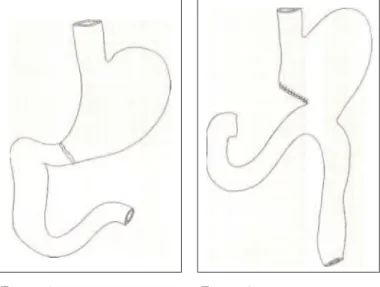 Figure 1 : anastomose  gastro-duodénale Jéjunale (Péan)