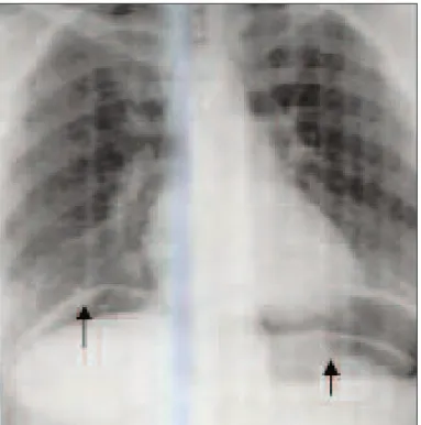 Figure 4 : pneumopéritoine